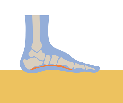 ¿Qué es la fascitis plantar?